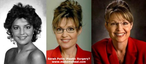 sarah-palin-plastic-surgery